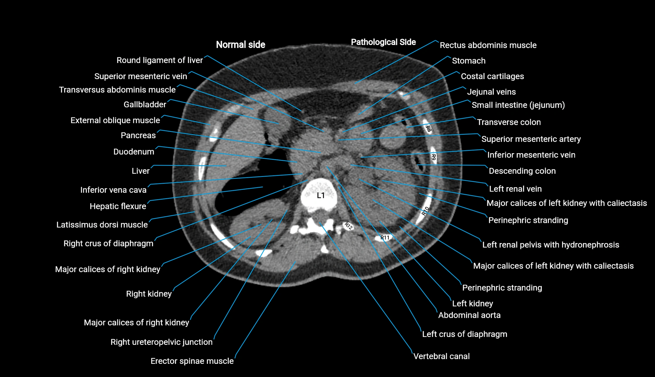 CT KUB axial cross sectional anatomy  radiology image -img-00201-00038.webp